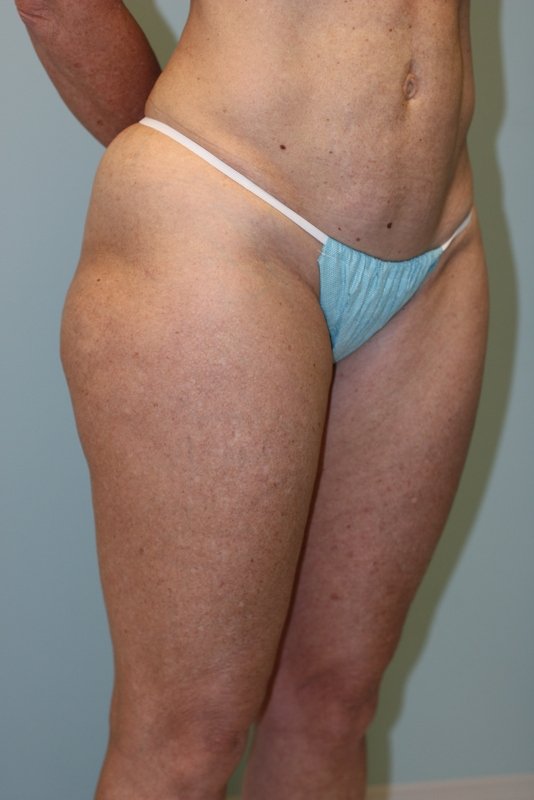 A patient before her butt lift surgery at Perimeter Plastic Surgery