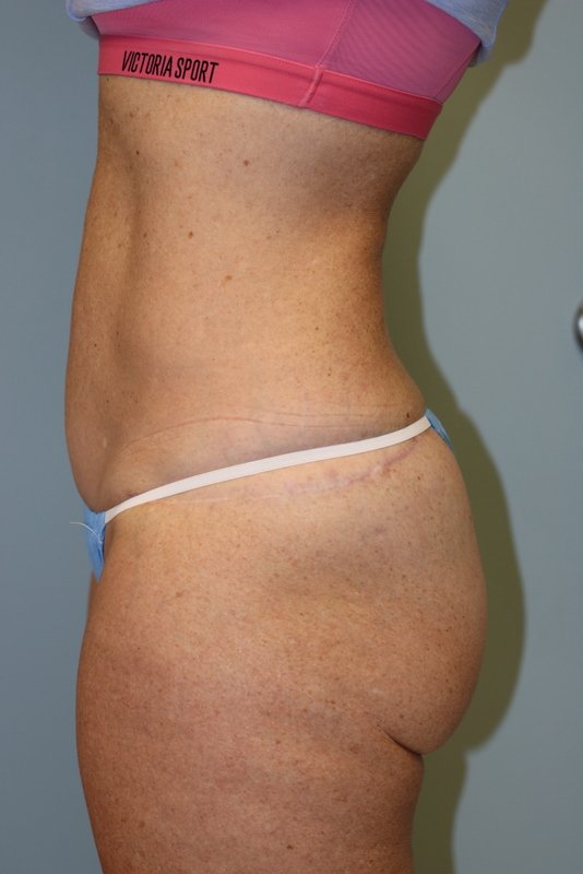 A patient after her butt lift surgery at Perimeter Plastic Surgery
