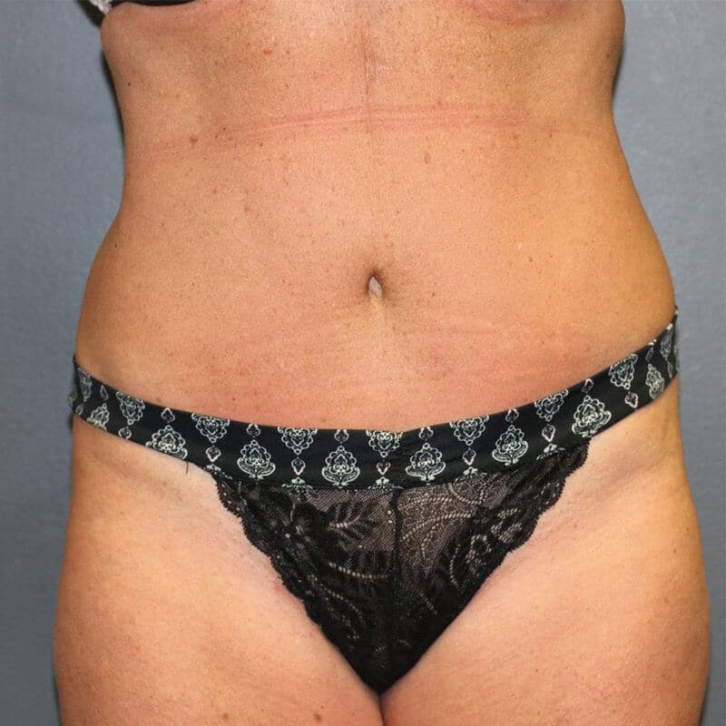 A patient woman wearing black underwear displaying her abdomen post-surgery.