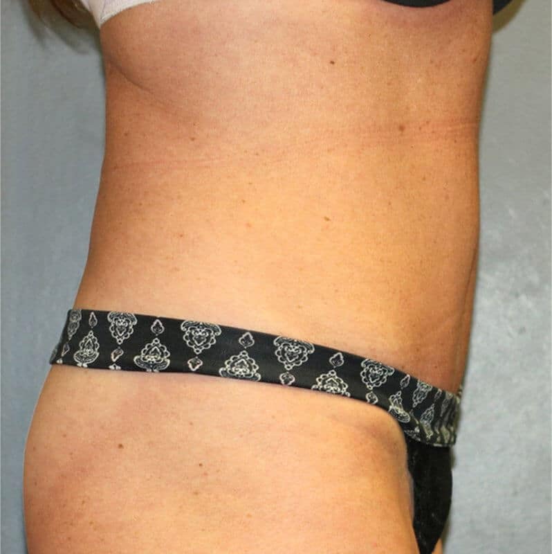 A patient shows the right side of her hips and tummy, wearing a black bikini, after the surgery