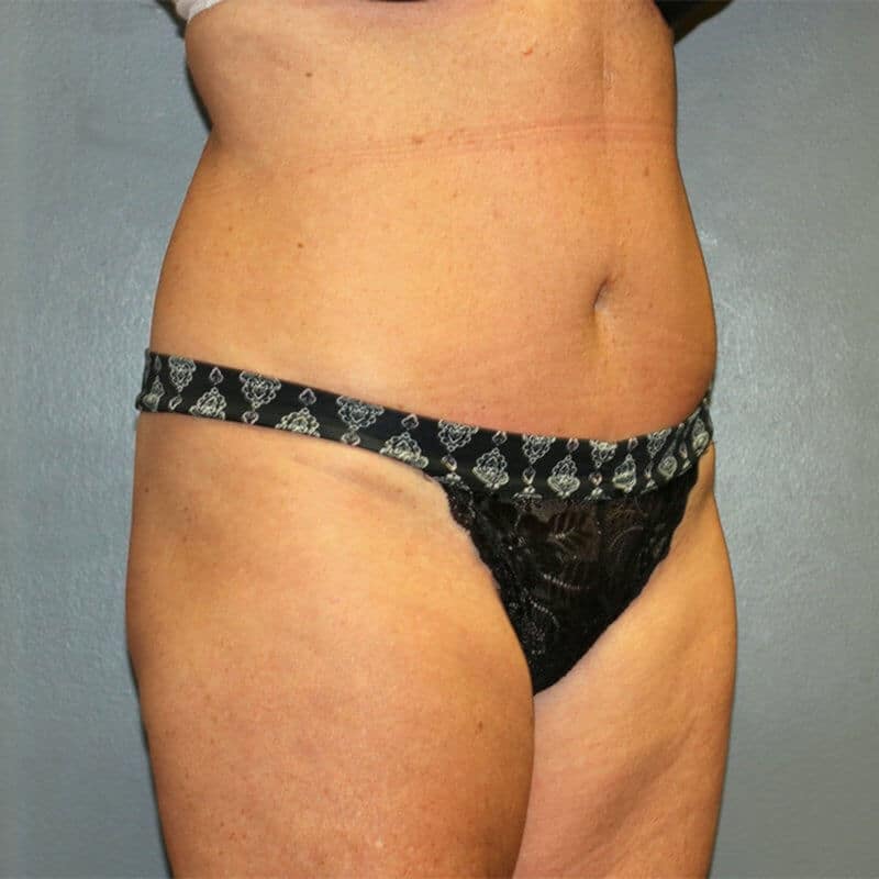 A patient in the right-angle side of her tummy after the surgery