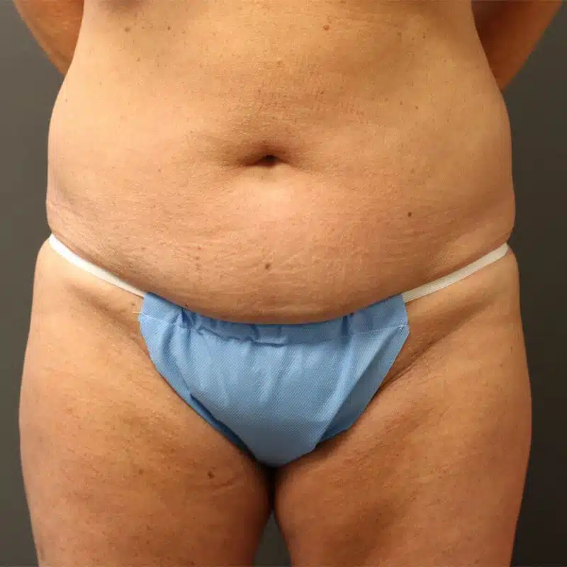 A patient wearing a sky-blue undergarment is shown in front angle, revealing his lower abdomen and thigh.