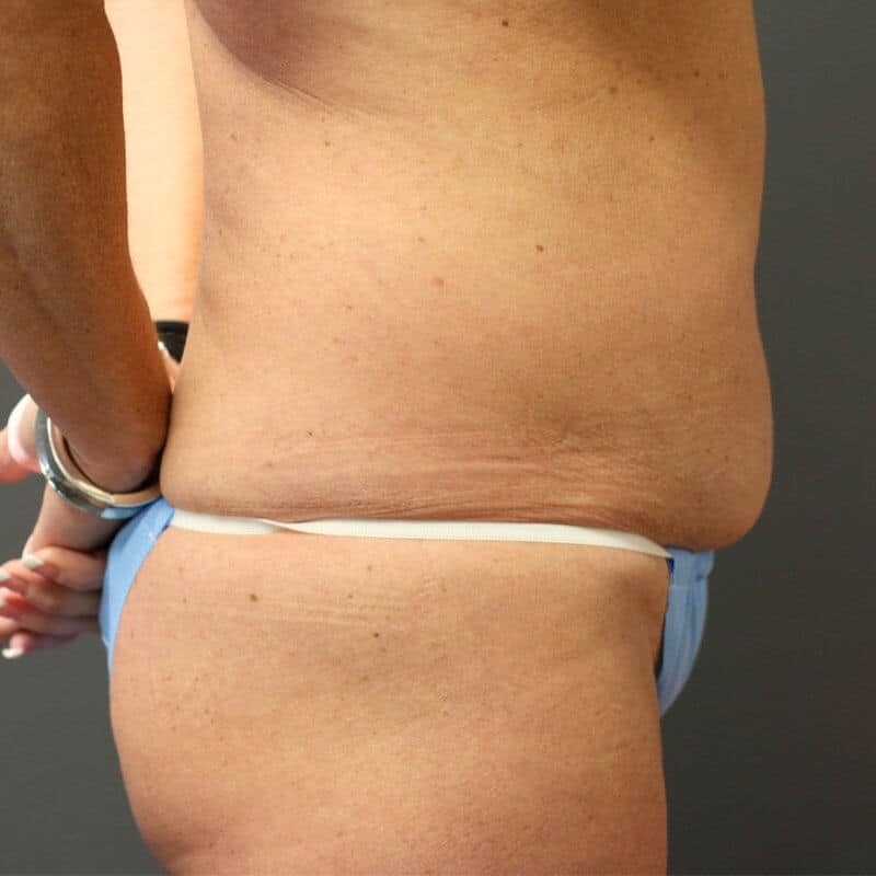 A patient woman showing the lower part of her right tummy before the surgery