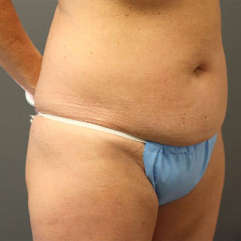A patient's view of her abdomen wearing a sky-blue bikini before surgery.