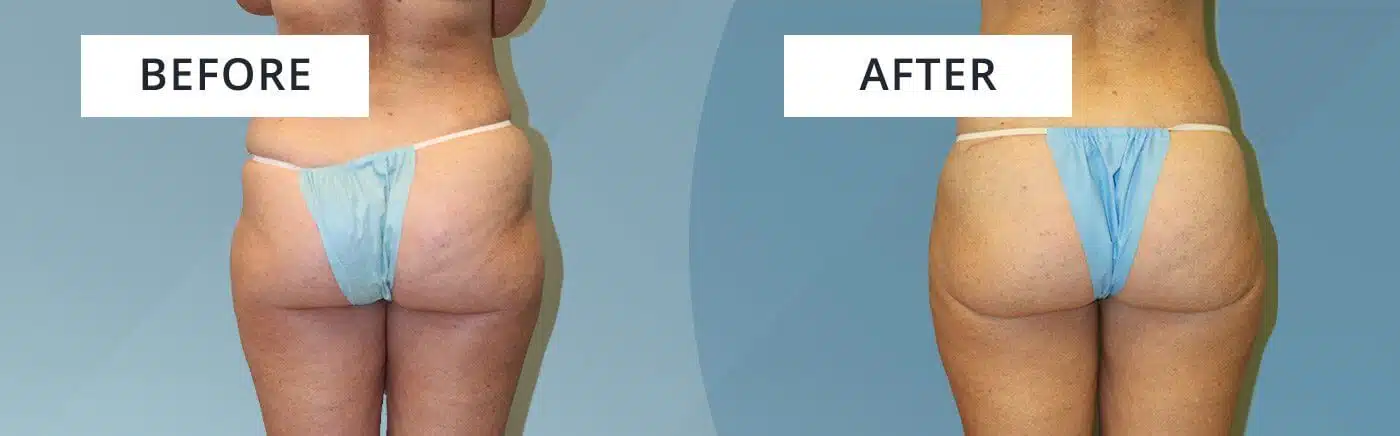 Atlanta Butt Lift / Thigh Lift Procedure