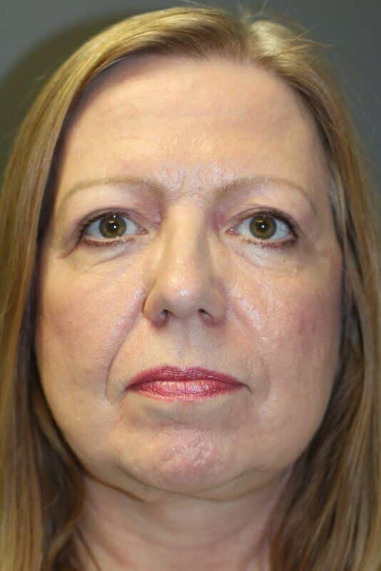 A front view of a female patient's face after her facelift procedure