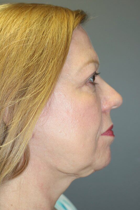 A woman's right side of face after the face lift procedure