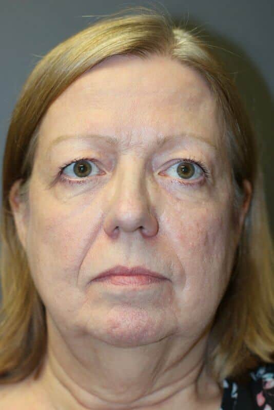 A front view of the patient's face before facelift surgery
