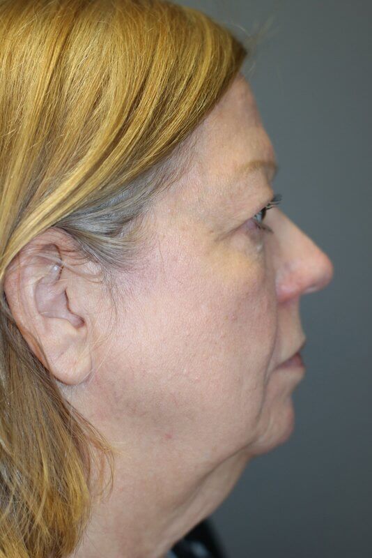 A woman's right view of her face before having a facelift procedure at Perimeter Plastic Surgery