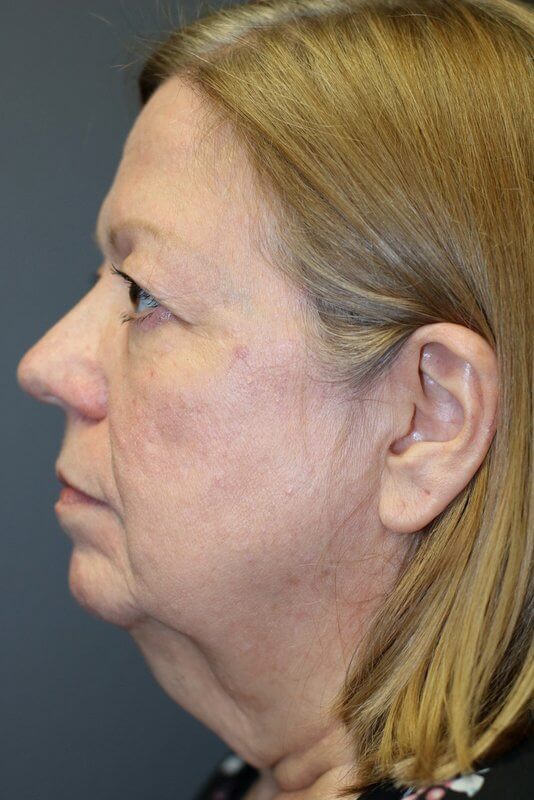 A face of a woman in the left view before having surgery