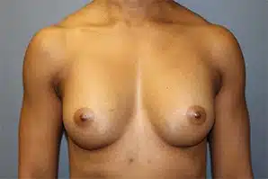 A patient's front angle of her breast after breast surgery.