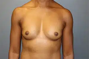 A patient's front view of her breasts, tummy and arms before undergoing surgery