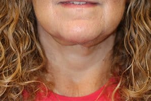 Neck lift After Front