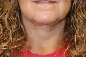 A patient's angle of her neck and chin after the successful surgery.