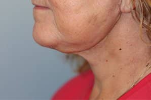 A patient's view of her neck after a neck lift procedure
