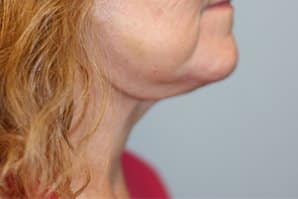 A woman's right side of her chin after having a facelift.