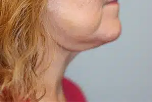 A woman's right side of her chin after having a facelift.