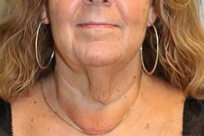 A patient's lower view of her face before neck lift at Perimeter Plastic Surgery