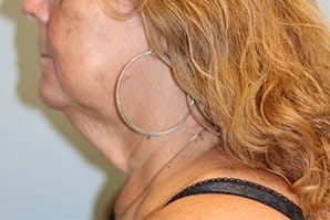 A patient's view of her left angle side neck and lower face before neck lift