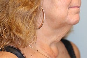 Neck lift Before Right