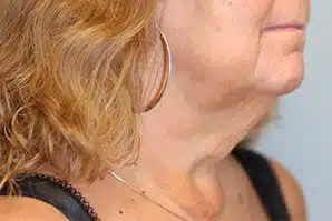 right side of a patient's neck before neck lift surgery