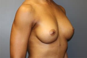 The patient's right-angle of breast, upper abdomen, and arm after the surgery.