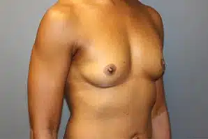 A patient woman's right angle view of her breasts and abdomen before surgery.