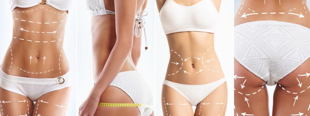 Different perspectives and surgical markings for a woman undergoing liposuction