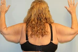 A woman's facing at the back, lifting her two arms, showing excess skin before arm lift surgery