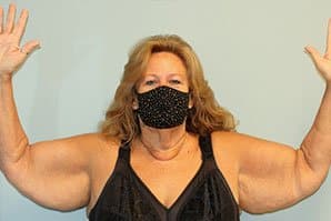 A patient's front angle of her body, spreading her two arms, is wearing a black bra and mask before arm lift surgery.