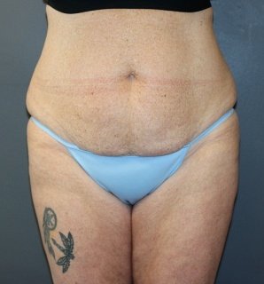 A patient, wearing a sky-blue bikini in central view of her tummy before the surgery