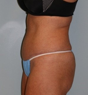 A patient wearing her sky-blue underwear and black bra in the left-sided view of her abdomen after the surgery.
