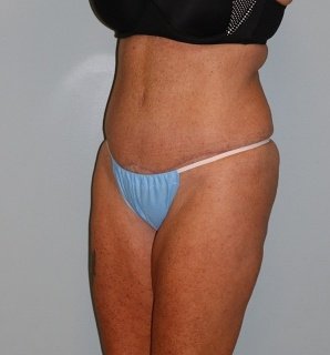 A patient woman in a left-angle view of her tummy and legs after the surgery