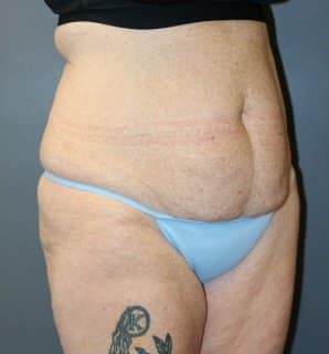 A woman in the right-angle wearing sky-blue underwear shows her abdomen before the surgery.