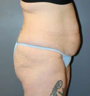 A woman wearing a sky-blue undergarment poses her body on the right side before surgery on her abdomen.