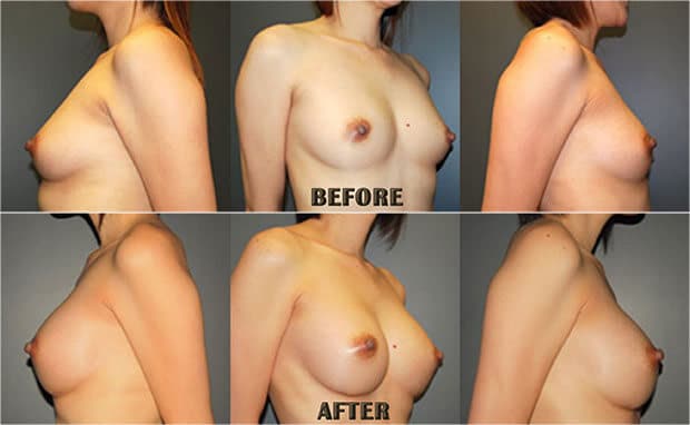 Here are a patient's different angles of her breasts and arms before breast augmentation surgery.