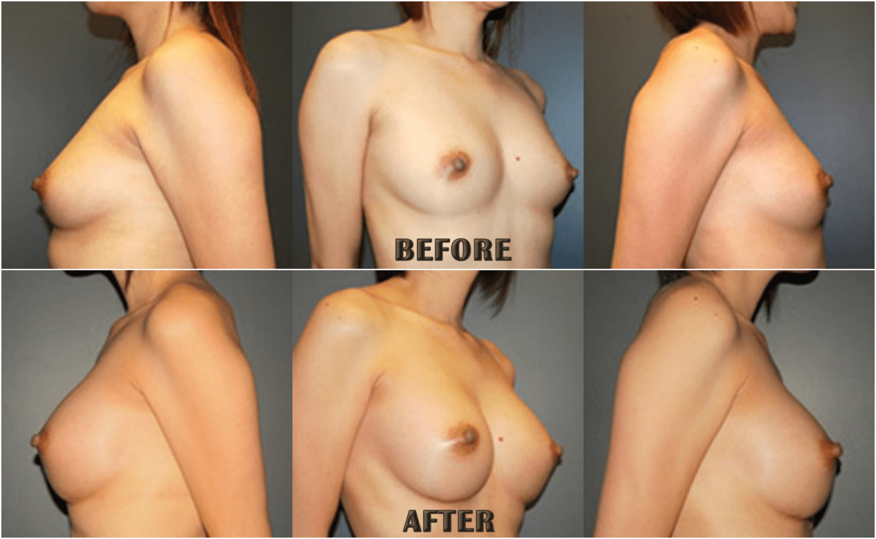 Breast Augmenation Before After Pics