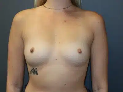 A pre-surgery front view of the patient's breasts and arms.