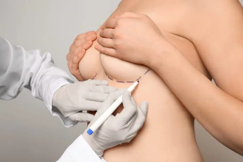 A doctor traces the patient's lower breasts using a blue marker.