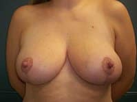A female patient's front angle of her breasts after breast reduction surgery.