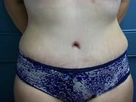A woman's slim abdomen after the surgery.