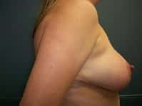 A right side of a patient in Perimeter Plastic Surgery shows her breast and arm after the surgery.