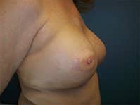 A post-surgery of the patient's breast.