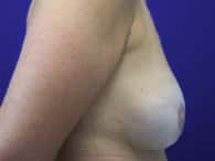 The right breast and arm of the patient after the surgical procedure