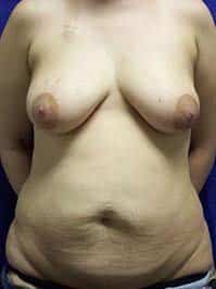 A patient in front view of the excessive skin of her breasts and tummy before the surgery