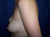 A patient poses in the left angle, exposing her breasts and arm and about to undergo surgery.