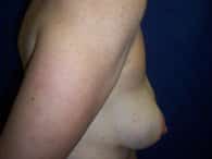 The view of a woman's breast before breast surgery