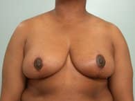 A woman's front view of her breasts and tummy result after the surgery