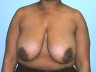A woman's front view of the excess skin of her breasts, tummy and arms before the surgery