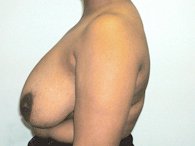 A patient's left angle of her breast and arm before the surgery.